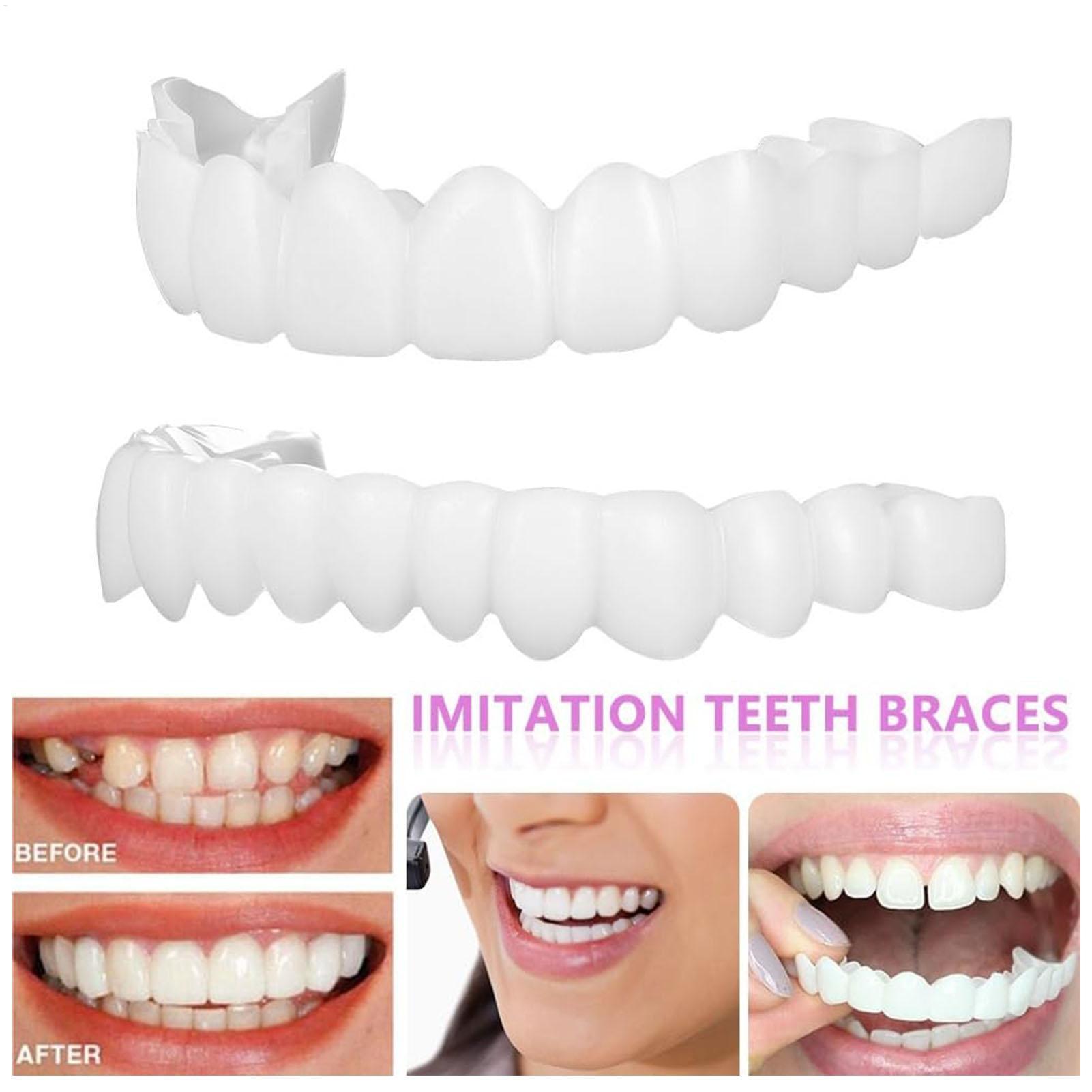 Teeth Whitening With Braces - Capa Dentária Superior e Inferior para