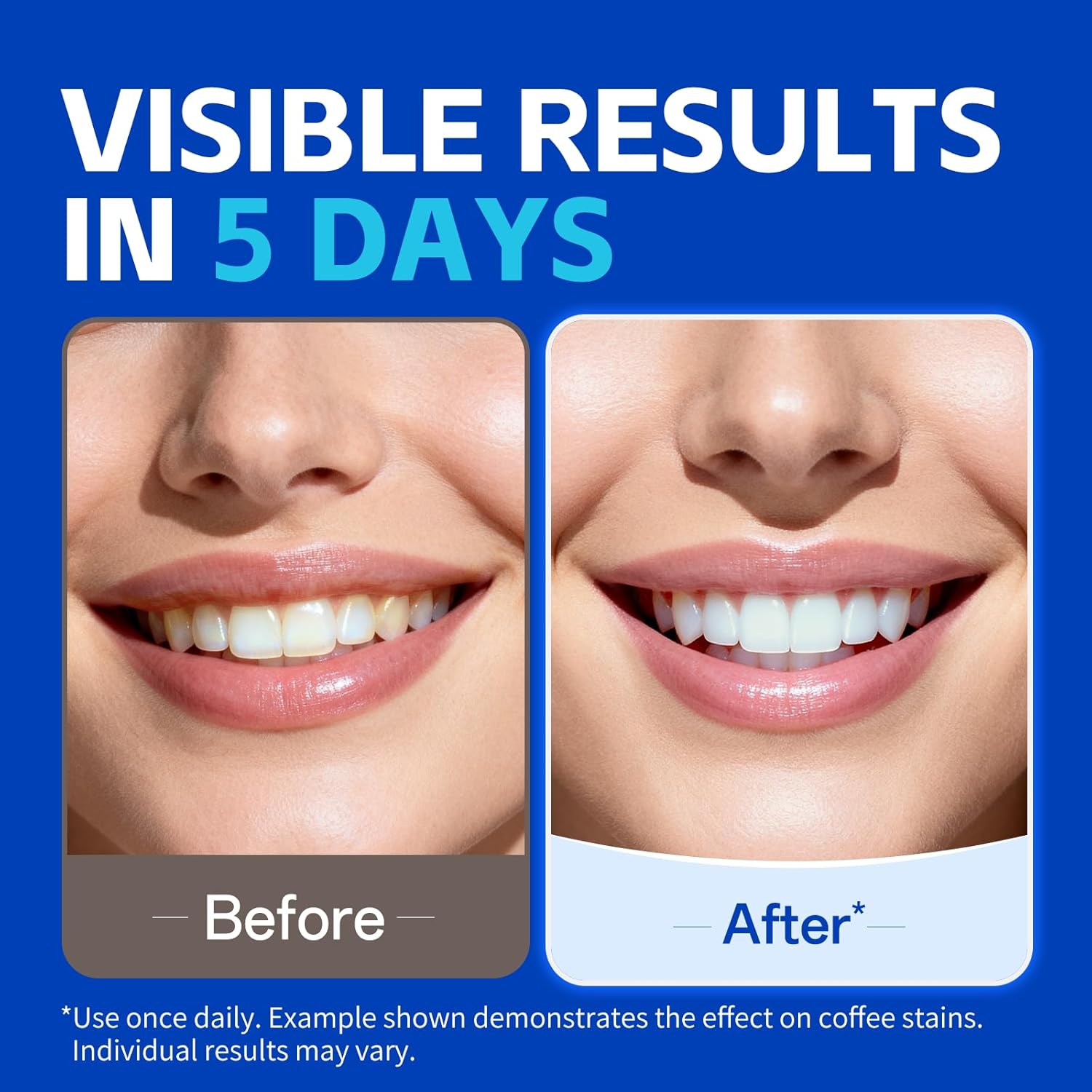7 pares de tiras clareadoras d - Teeth Whitening Retainer avaliação e preço