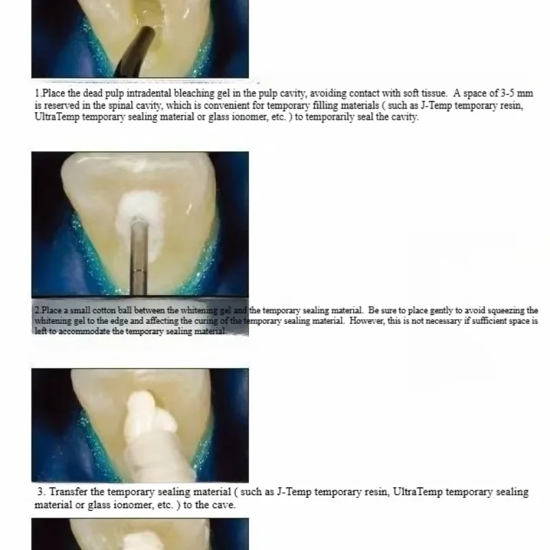 Materiais de restauração oral  - Teeth Whitening Effects avaliação e preço