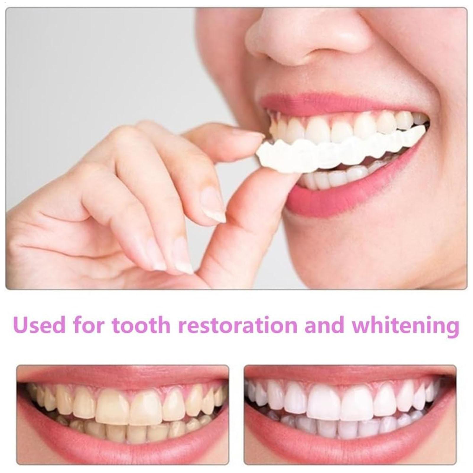 Capa Dentária Superior e Infer - Teeth Whitening With Braces avaliação e preço