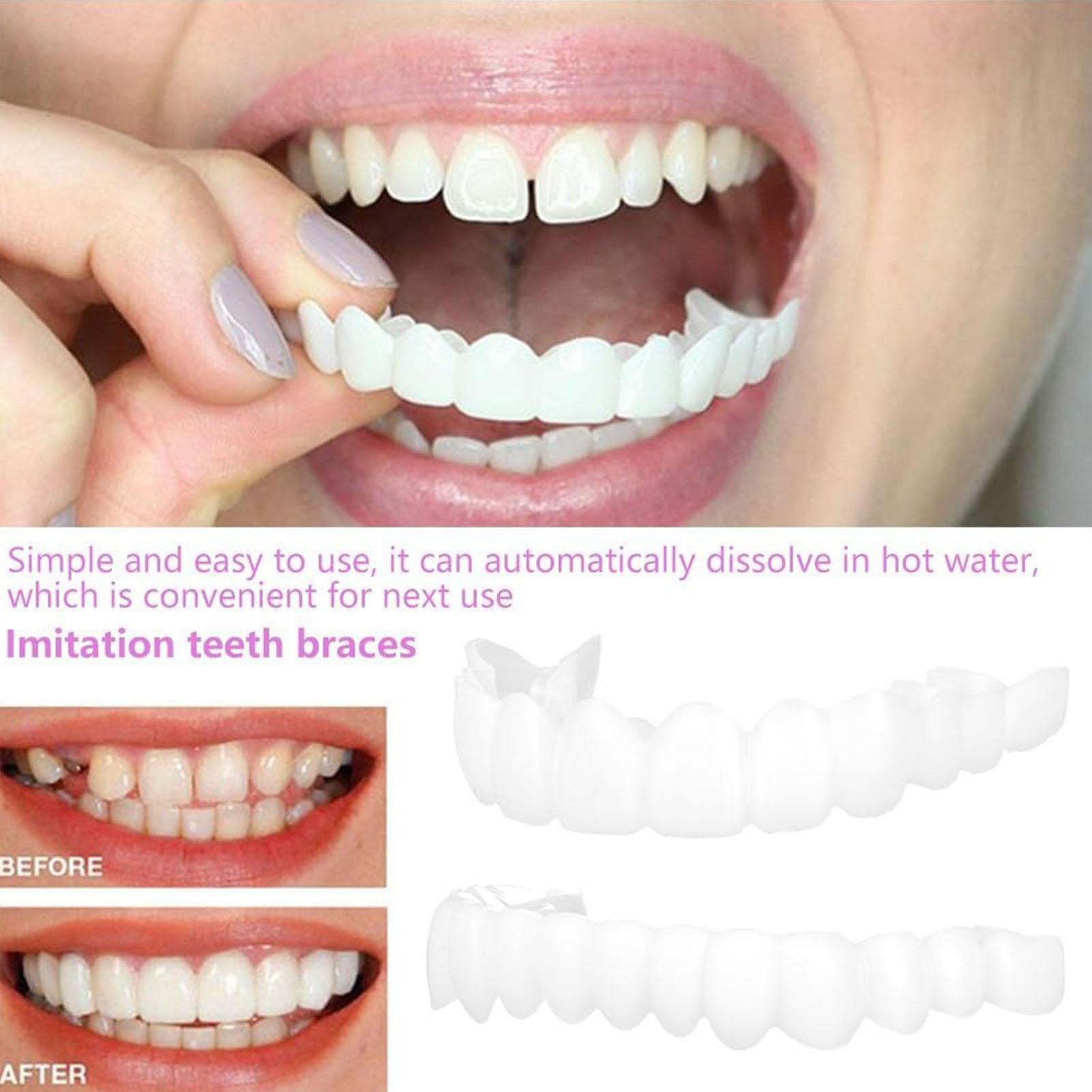 Capa Dentária Superior e Infer - Teeth Whitening With Braces avaliação e preço