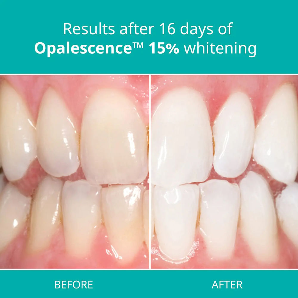 Kit de clareamento profissiona - Teeth Whitening Gel Refills avaliação e preço