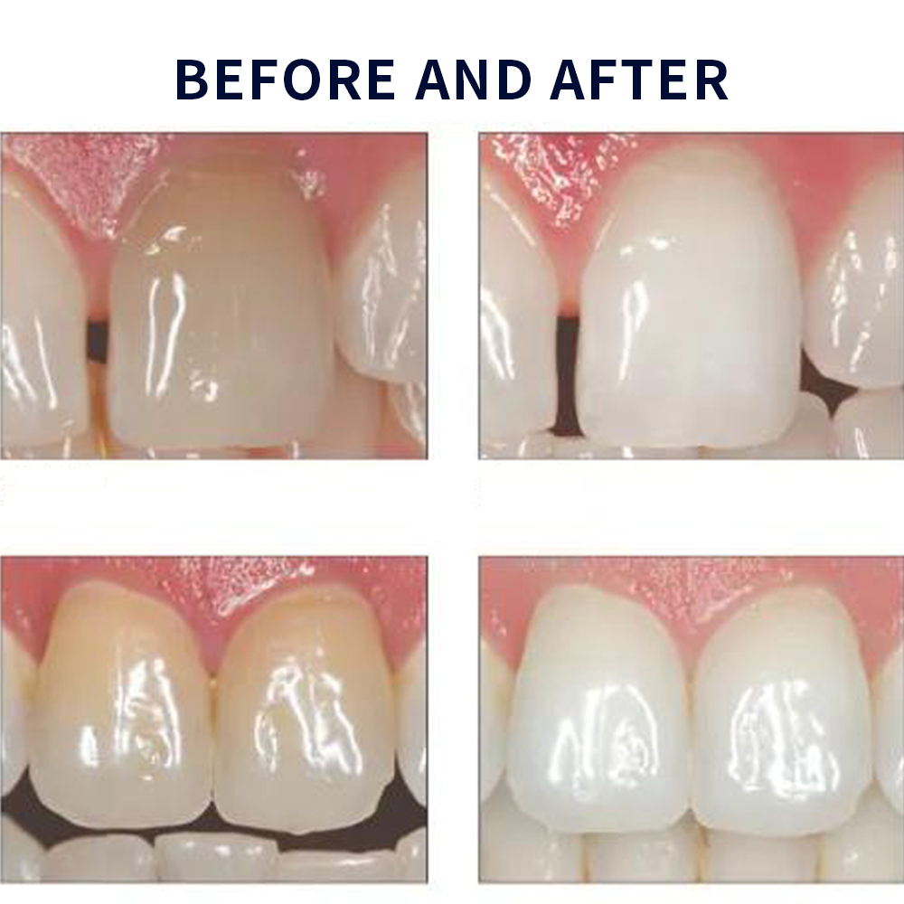Opalescência Whitening Gel Kit - Teeth Whitening Gel Peroxide avaliação e preço
