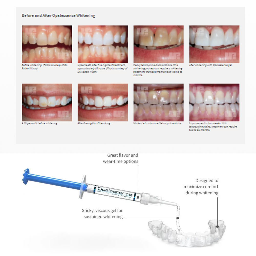 Opalescência Whitening Gel Kit - Teeth Whitening Gel Peroxide avaliação e preço