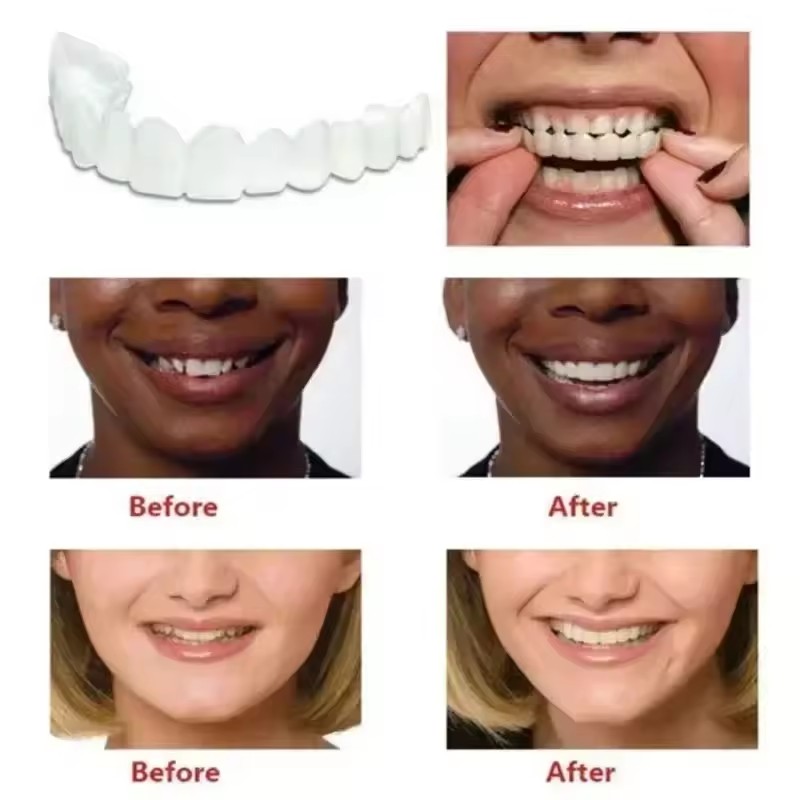 Veneers Dentários para Claream - Teeth Whitening With Braces avaliação e preço