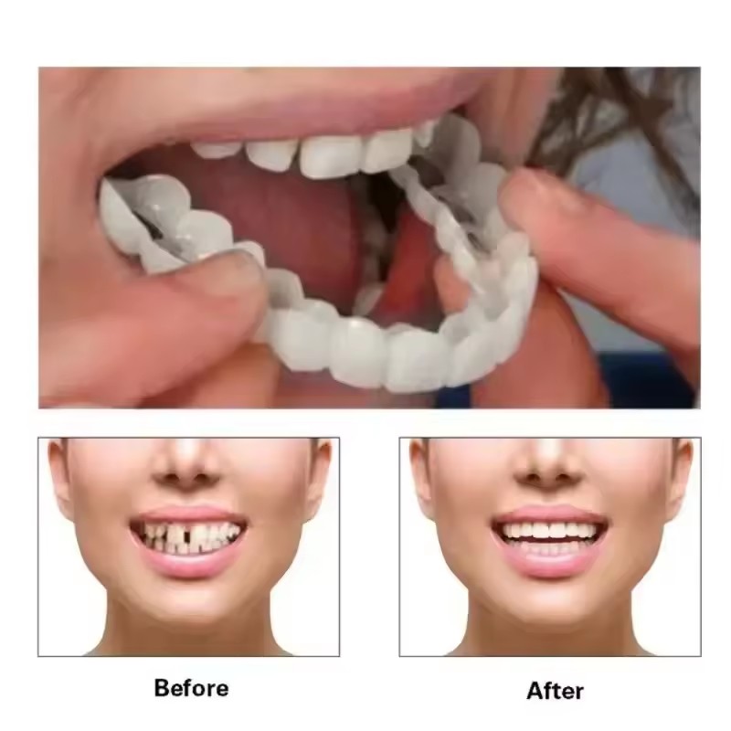 Veneers Dentários para Claream - Teeth Whitening With Braces avaliação e preço