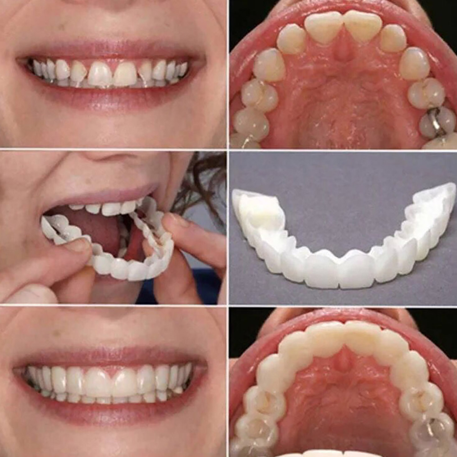 Veneers Dentários para Claream - Teeth Whitening With Braces avaliação e preço