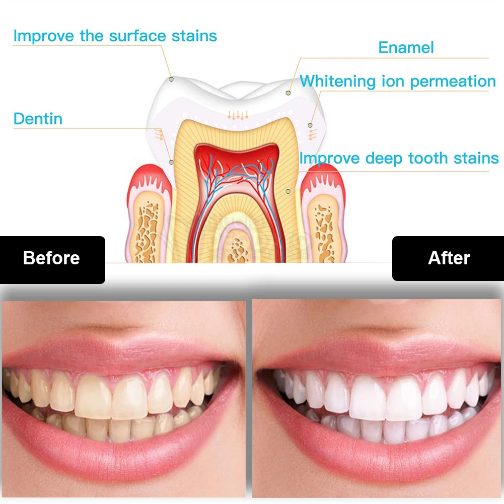 Kit de clareamento dental dos  - Teeth Whitening Gel Peroxide avaliação e preço