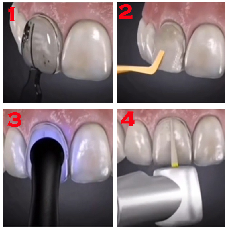 Kit de Moldes para Facetas Den - Teeth Whitening Kit With Light avaliação e preço