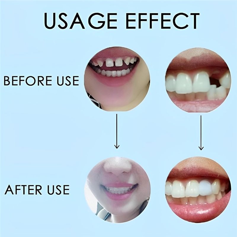 [NOVO! ABMK】 2 Pares, Restaure - Teeth Whitening With Braces avaliação e preço